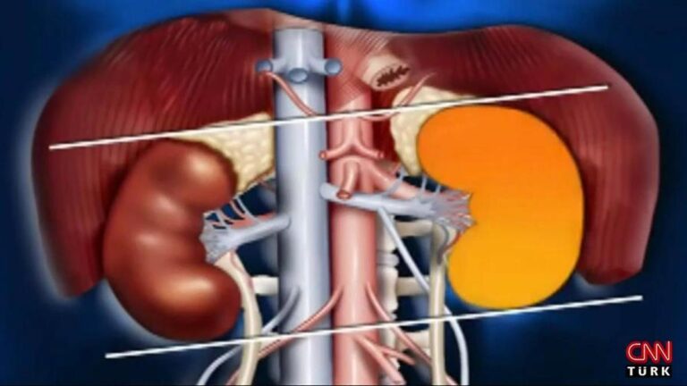 Böbrek taşında bu belirtilere dikkat
