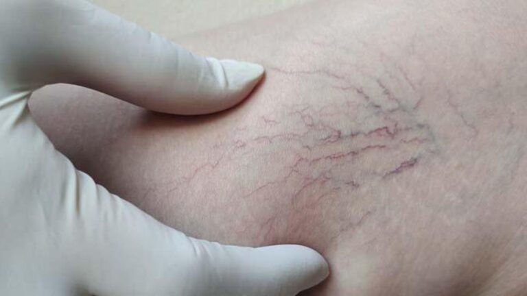 Yaz sıcakları varisleri tetikliyor