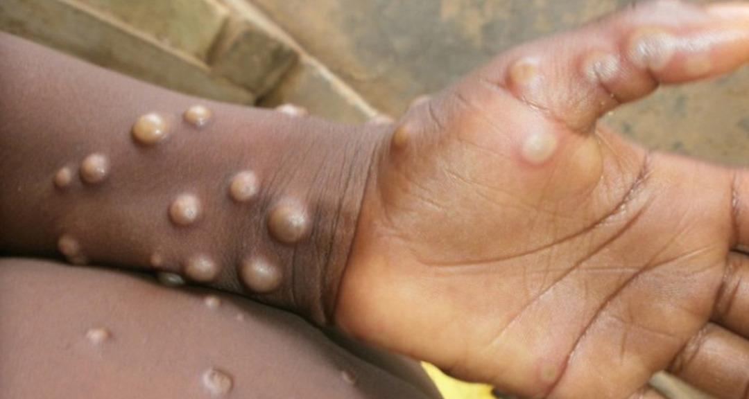 DSÖ M-pox Virüsü Uyarısı: Salgın kıtayı aştı! Kontrol altında tutmak 4